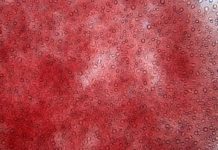 10 Sneaky Signs of Iron Deficiency