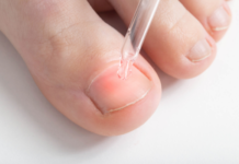 7 Home Remedies for Nail Fungus That Work